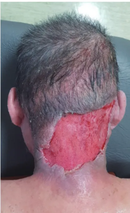 Fig. 2. The sternocleidomastoid muscle, semispinalis capitis muscle,  and trapezius muscle were exposed, and the defect measured 25×20  cm.