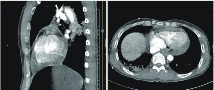 Fig. 2. Chest computed tomography shows pericardial effusion (hemopericardium) at trauma bay.