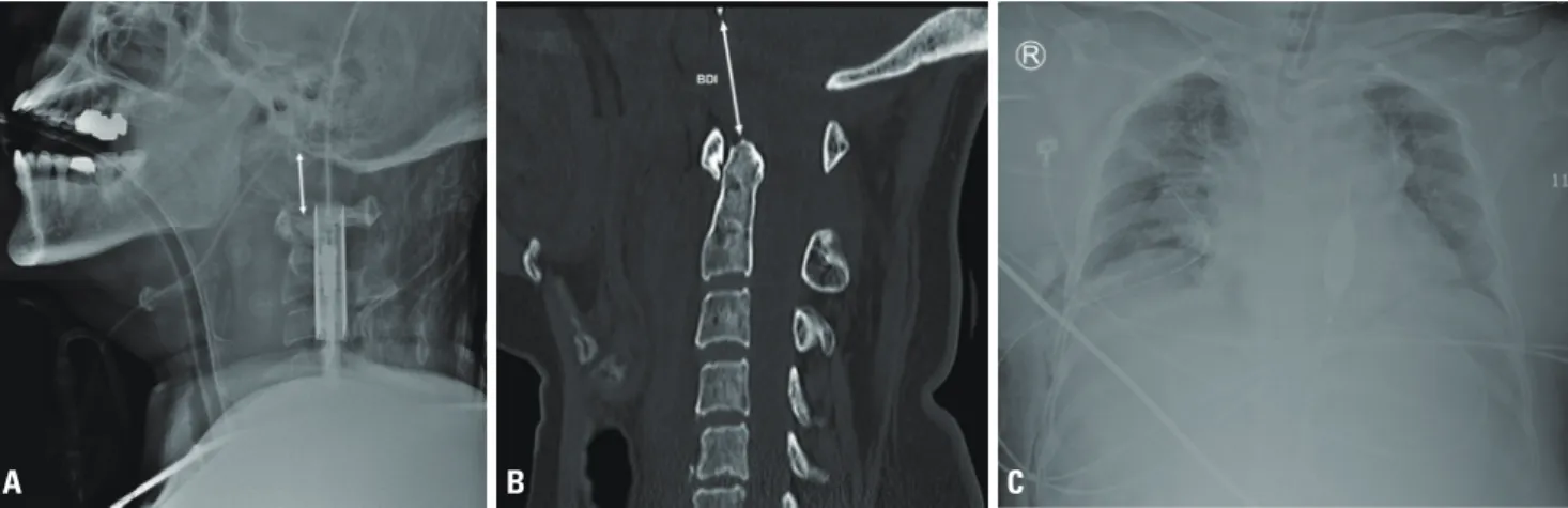 Fig. 1. (A) Lateral-view radiograph of the cervical spine showing a distraction-type AOD