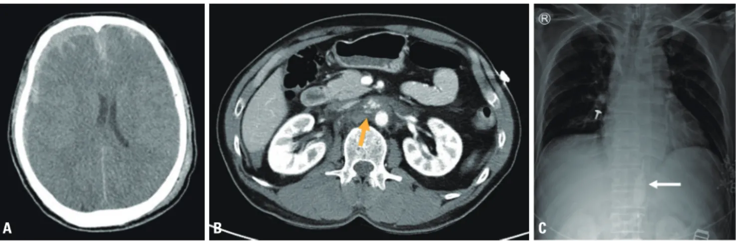 Fig. 2. (A) Brain computed tomography (CT) scan showing subdural hemorrhage and subarachnoid hemorrhage in the right hemisphere with midline  shifting and diffuse brain edema