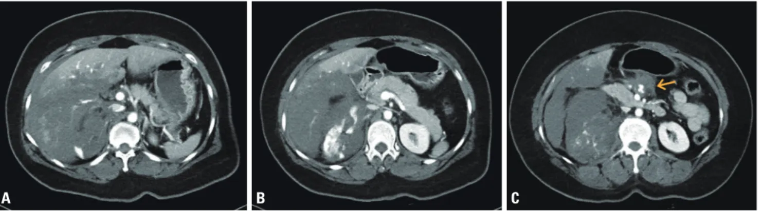 Fig. 1. Preoperative computed tomography of the abdomen. (A) Grade V liver laceration with extravasation