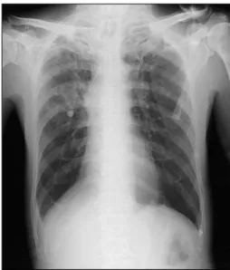 Figure  1.  Chest  X-ray  showed  underlying  chronic  ob- ob-structive  pulmonary  disease  and  tuberculosis  sequale  in both  upper  lungs.