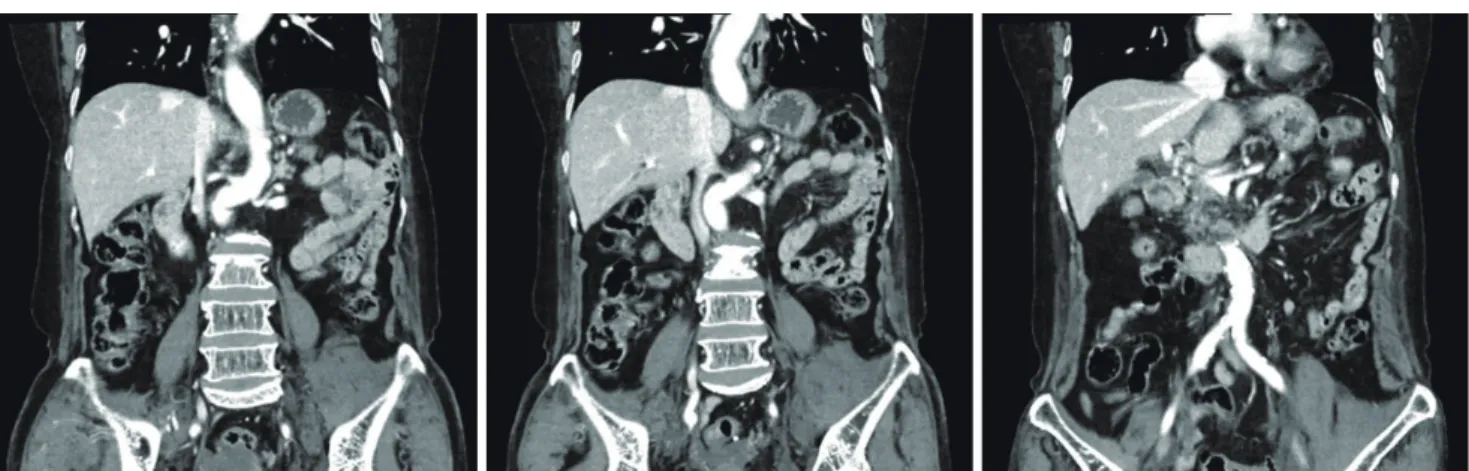 Fig. 2. Computed tomography shows tortuous aorta of the patient. Balloon reposition from Zone III to Zone I was impossible due to the anatomy.