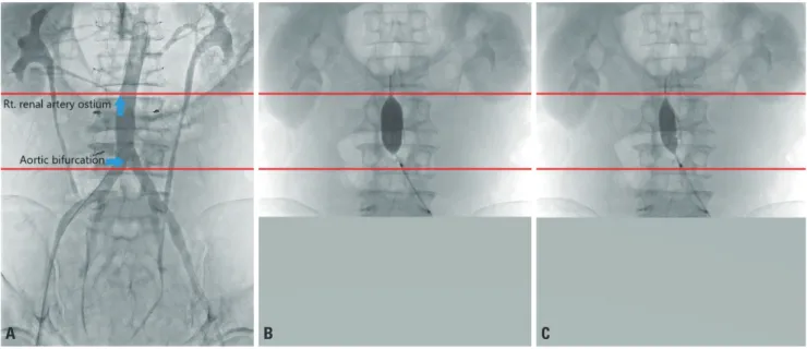Fig. 2. These are fluoroscopy images of REBOA and Zone III is marked with two red lines