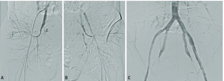 Fig. 3. Angiography under real-time fluoroscopy showed the following findings. (A) Active bleeding from the right internal iliac artery, (B) active bleed- bleed-ing from the left internal iliac artery, (C) follow up angiography after embolization