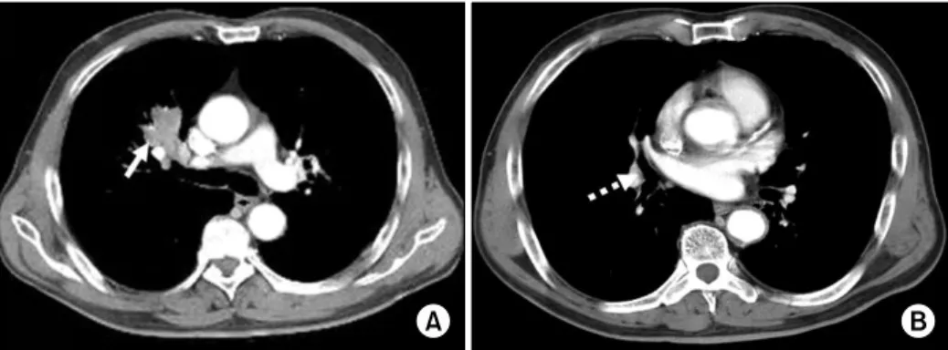 Figure  1.  Preoperative  images  of  CT  showed  (A)  about  3.7×2.7  cm  sized  heterogenous  enhancing  low  density  mass  with total obstruction of anterior segmental bronchus of right upper lung (solid arrow), (B) proximal portion of right middle and
