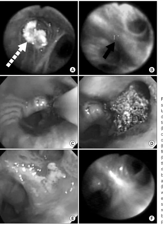 Figure  2.  Initial  broncho- broncho-scopy  showed  (A)   intra-luminal mass in RB3 (white  dashed  arrow)  by   conven-tional  bronchoscopy,  and  (B)  ‘loss  of   autofluores-cence’  in  superior  segment of  right  lower  bronchus  (black solid arrow) 