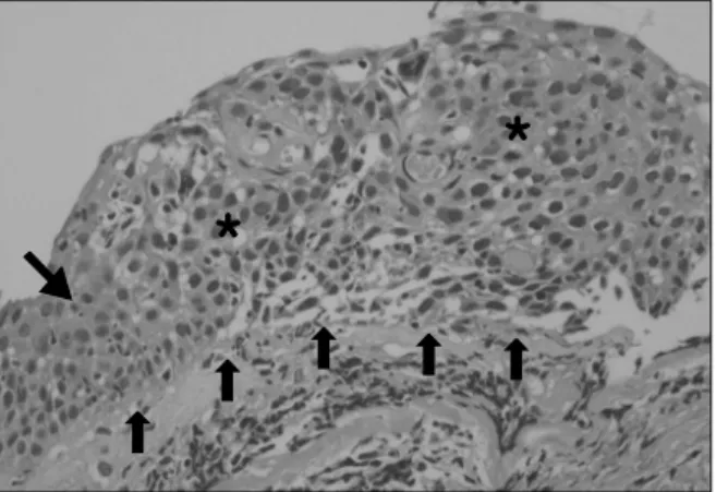 Figure 3. The report from pathologist revealed  ‘carcinoma in situ’ for superior segment of right lower bronchus