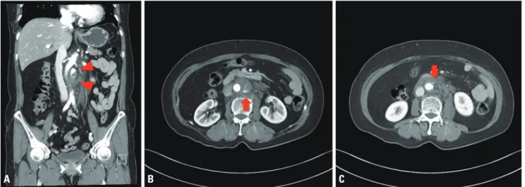 Fig. 1. Extravasation of contrast material adjacent to the infrarenal abdominal aorta on abdominal computed tomograms
