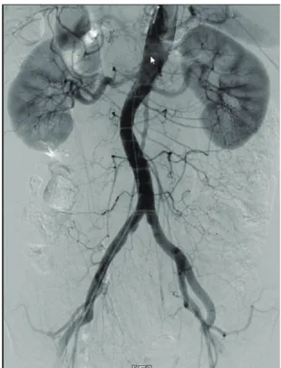 Fig. 3. Follow-up computed tomograms. (A) The size of hematoma adjacent to the abdominal aorta decreased without any evidence of further ongo- ongo-ing bleedongo-ing on the 10th hospital day (arrow heads)