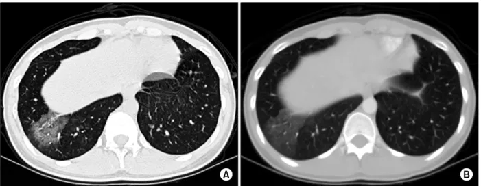 Figure  1.  Preoperative  chest  x-ray  shows  no  abnormal  finding. 100  ml  미만이었으며,  월경이  끝나면  객혈이  없어졌다