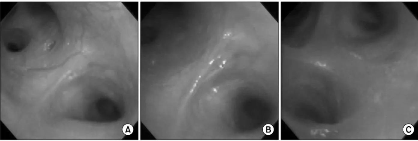 Figure  3.  Engorged  blood  vessels  were  noted  in  the  right  lower  lobar  bronchus  (A)