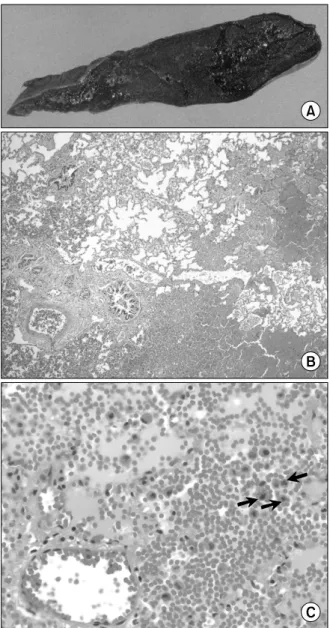 Figure  4.  A  lobectomy  specimen  of  right  lower  lung,  measuring  15×10×5  cm,  reveals  a  pooly-demarcated  hemorrhagic  mass  (4×3.5×1.5  cm),  10  cm  apart  from the bronchial resection margin (A)