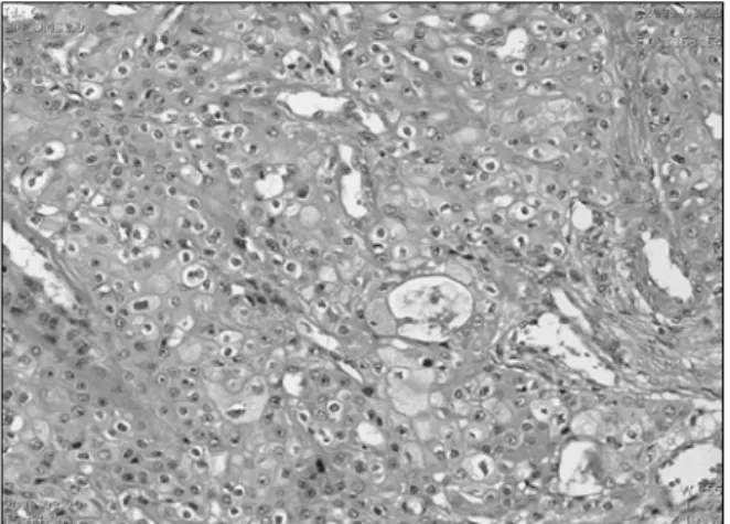 Figure  5.  A  yellowish  solid  endobronchical  mass  was  seen,  which  is  1.8×3.0  cm  sized  and  arising  from  the  bronchial  wall.