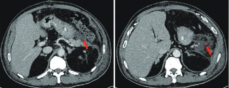 Fig. 1. Computed tomography performed 9 days post-splenectomy showing a collection (arrows) at the splenic bed/pancreatic tail with a close   relationship to the greater curvature of the stomach