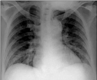 Figure  2.  Contrast  enhan- enhan-ced  chest  computed   to-mography  scans  show  air  (arrow)  in  the  left   brachio-cephalic  vein  (A)