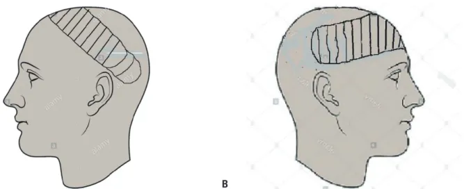Fig. 5. Schematic diagram of the right fronto-parieto-occipital flap. (A) Left fronto-parieto-occipital flap pre-elevation