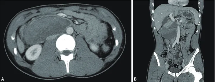 Fig. 1. Initial abdominal computed tomography showed a huge intramural hematoma in the third and fourth portions of the duodenum