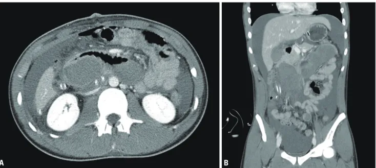 Fig. 2. A photograph from the first operation shows intramural hema- hema-toma of the third and fourth portions of the duodenum.