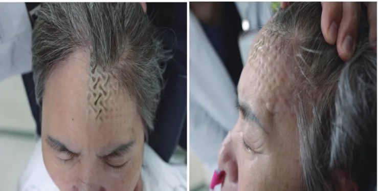 Fig. 3. Extrusion after cranioplasty. Extrusion of a mesh was defined as severe thinning of the soft tissue and skin to show the implanted mesh patterns  without wound dehiscence