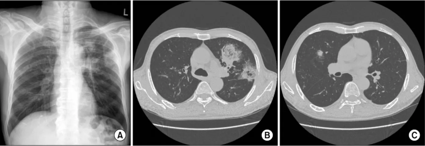 Figure  1.  Initial  chest  PA  (A)  and  chest  CT  (B,  C)  showed  two  ground  glass  opacities  with  hyperlucent  area  in  left upper  lobe  and  another  small  ground  glass  opacity  with  suspicious  air-crescent  sign  in  right  upper  lobe.