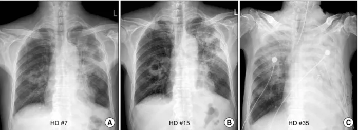 Figure 4. Serial Chest X-rays showed rapid progressive lesion in both lung field. Compared with chest X-ray at admission (A),  follow  up  X-ray  at  15th  day  showed  to  progress  on  both  lung  fields  (B)