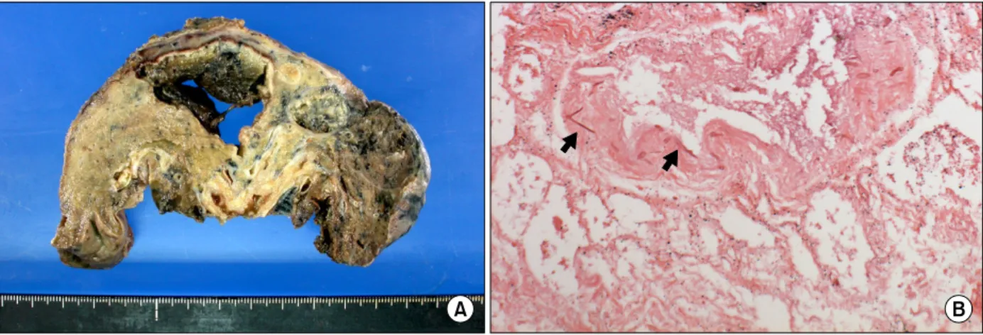 Figure  5.  Gross  (A)  and  microscopic  finding  (B)  from  surgical  specimen.  Invasion  of  mucorales  hyphae  into  pulmonary  vascular  wall  was  observed  (arrow,  H&amp;E  stain,  ×400).