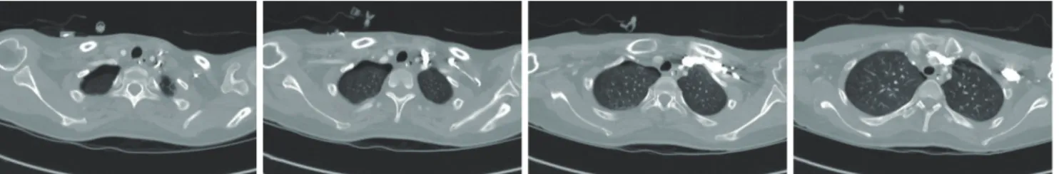 Fig. 4. Chest computed tomography images. Pneumothorax was noted at the right lung apex.