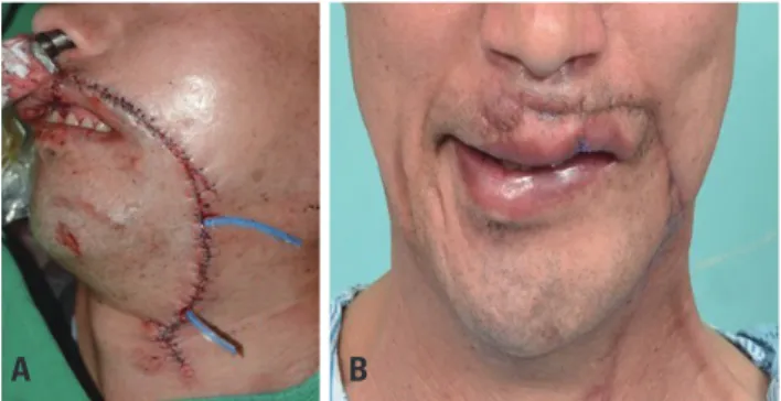 Fig. 2. (A) Primary repair with emergency open reduction without graft  surgery of bone and skin