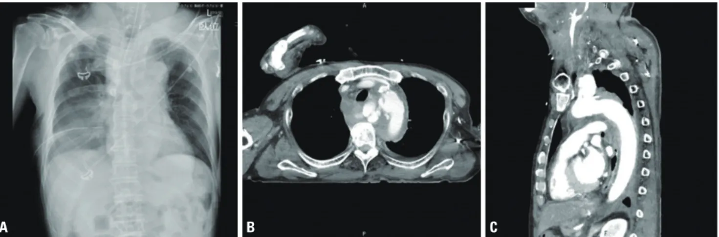 Fig. 1. A chest X-ray (A) and a chest CT scan with contrast (B, C) on arrival. He had already been intubated at the previous hospital, and a chest tube  had also been placed in the right cavity (A)