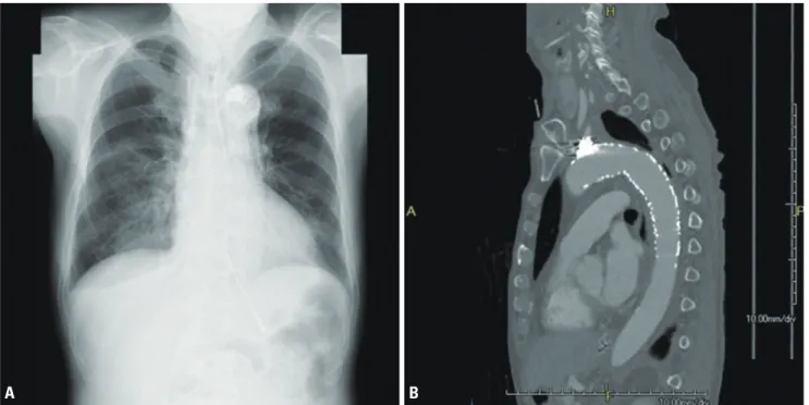 Fig. 3. The gastroscopy at the previous hospital. It revealed a cavity  with clot suggesting AEF on the upper esophagus (black arrow)