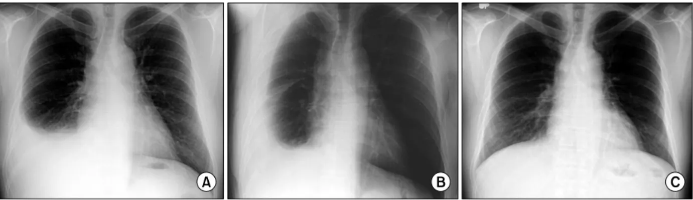 Figure  1.  Initial  chest  PA  &amp;  right  decubitus  show  a  right  pleural  effusion  (A,  B)