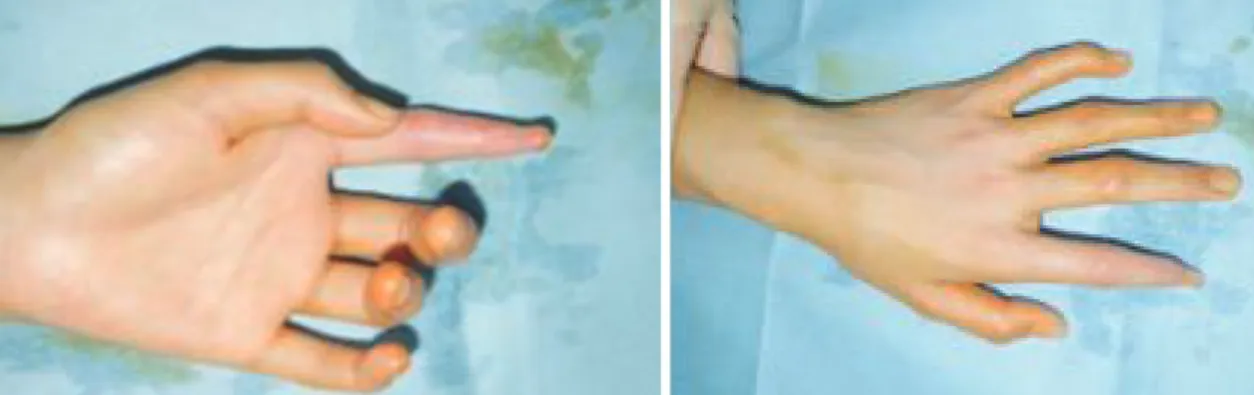 Fig. 3. One week postoperative photograph of donor site of bilateral  2nd toe pulp free flap.