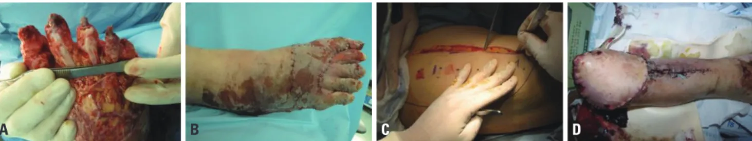 Fig. 1. (A) Degloving injury of the forefoot. (B) Immediate application of biologic dressing using stripped skin tissue