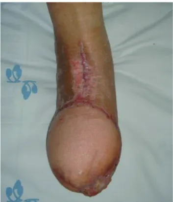 Fig. 3. Photograph of the foot at postoperative 6 months after the debulking procedure.