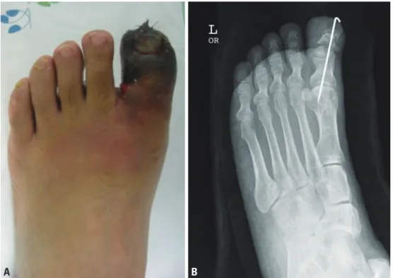Fig. 4. (A) Necrosis of the skin and  soft tissue in the left big toe. (B)  Unstable fixation of the 1st distal  phalanx.
