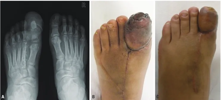 Fig. 5. (A) The K-wire was removed at 3 weeks postoperatively. (B) Preoperative photograph before the secondary flap debulking procedure