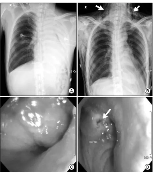 Figure  1.  The  chest  PA  and  bronchoscopic  finding  before  (A,  C)  and  after  (B,  D)  cryotherapy  in  case  2