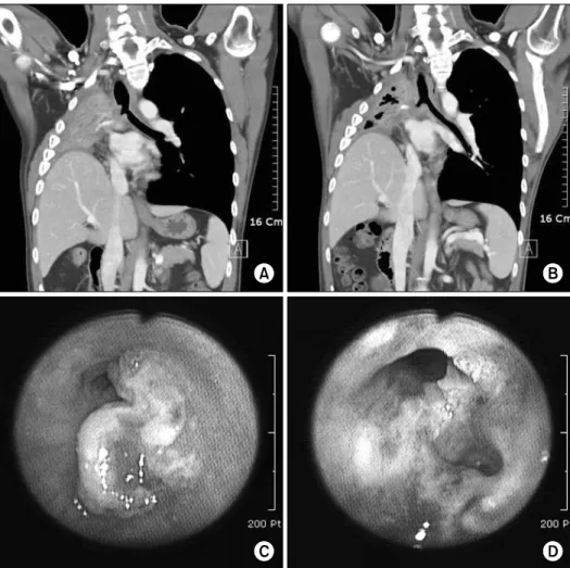 Figure 2. The chest PA and bronchoscopic finding before (A, C) and after (B, D) cryotherapy in case 3
