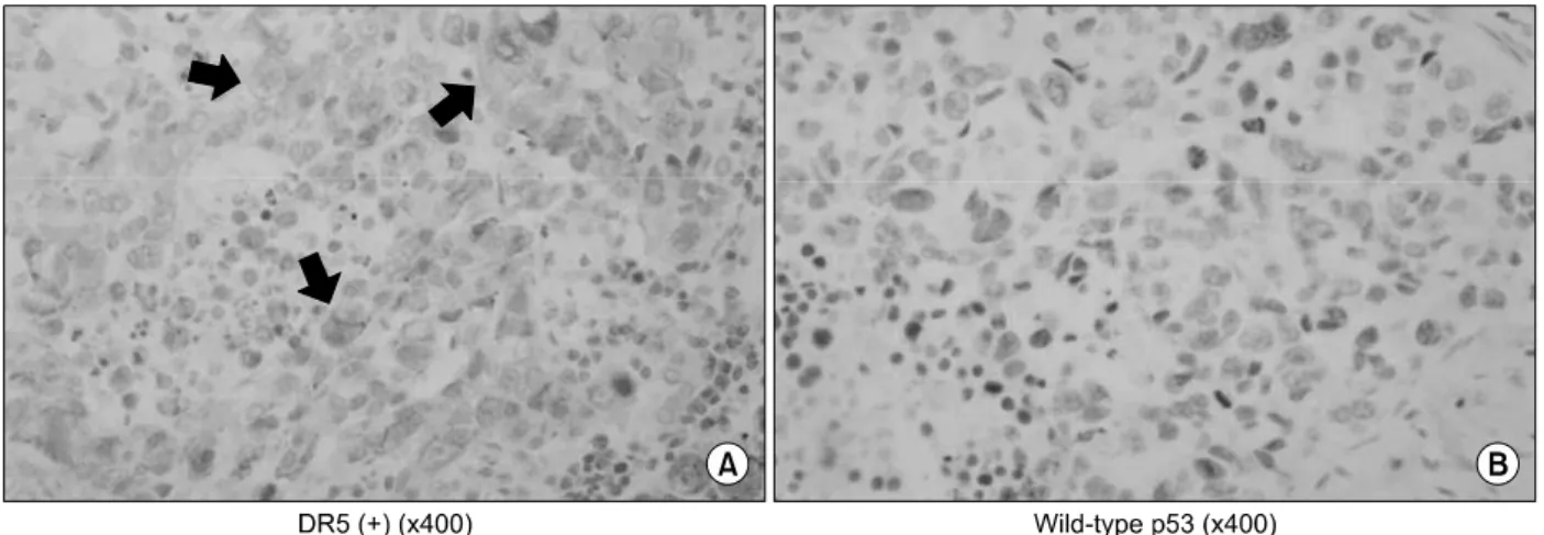 Table  3.  The  correlation  between  DR5  expression  and  clinical  parameters r  p  Age      0.0214  0.9087  Sex  −0.2818  0.1313  Pathologic  types      0.4504  0.0742 T  stage      0.0858  0.6464  N  stage      0.0846  0.6510  Pathologic  staging  −0.