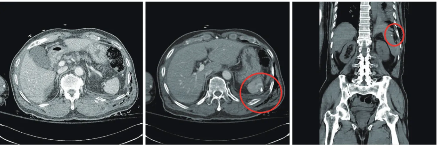 Fig. 1. Chest computed tomography (CT) and abdominopelvic CT finding, red circle indicates a foreign body like a bone fragment in the spleen and  subcapsular hematoma in initially.