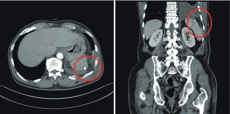 Fig. 2. Follow-up abdominopelvic computed tomography after 7 days, fat density increased in the thoracic cavity above spleen and retained a foreign  body in the spleen (red circle)