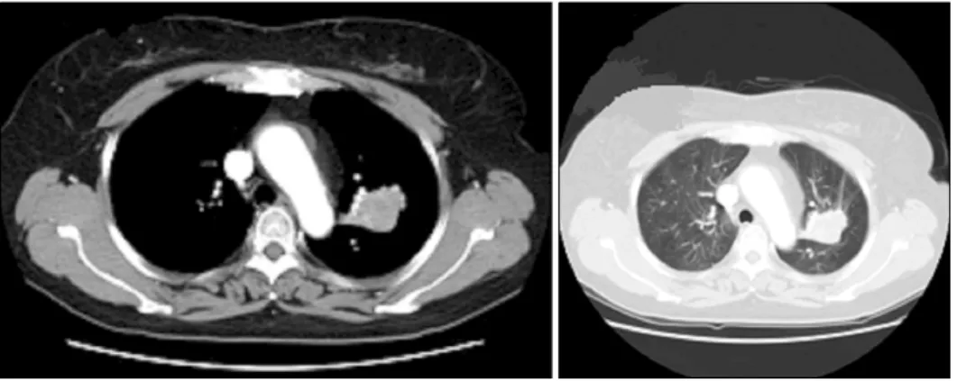 Figure 2. Conventional chest CT scan reveals solitary 3.5 cm sized lung  mass in left upper lobe without lynphadenopathy.