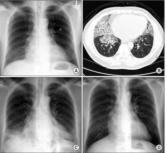Figure  1.  Chest  X-ray  on  admission  (A)  showed  mild  infiltrates  on  both  lower  lung  zone  and  diffuse  ground-glass opacities were observed  at  both  lower  lung  fields  on  high   reso-lution  computed   tomog-raphy (B)