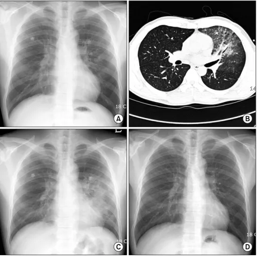 Figure  2.  Chest  X-ray  on  admission  (A)  showed  mild  infiltrates  on  left  mid  lung  zone  and  diffuse  ground-  glass  opacities  were   ob-served at left upper lobe on  high  resolution  computed  tomography  (B)