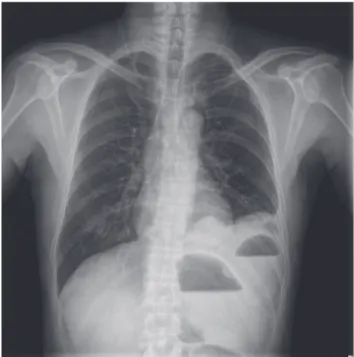 Fig. 1. Chest X-ray of the patient. Air-fluid levels are seen in the left tho- tho-racic cavity.