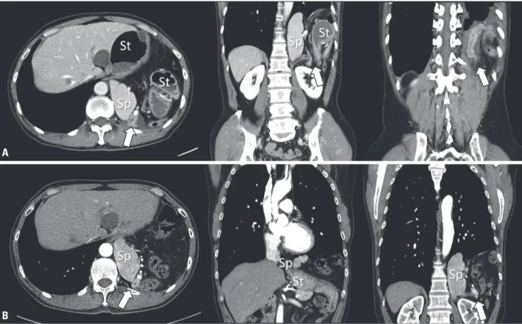 Fig. 2. CT of the patient. Abdominal CT of the visit day show the findings of left lateral diaphragmatic hernia of the stomach, spleen, colon, and pan- pan-creas (arrows)
