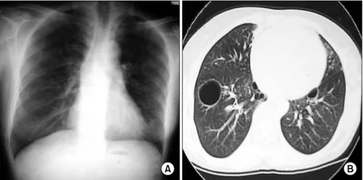 Figure  1.  Chest  radiographs  and  computed tomography  at  initial  visit. (A)  Chest  radiographs  showing  bilateral  multiple cysts,  and  (B)  chest  CT  showing  multiple  well-demarcated,  variable-sized  cystic  lesions  in  both  lung  fields.