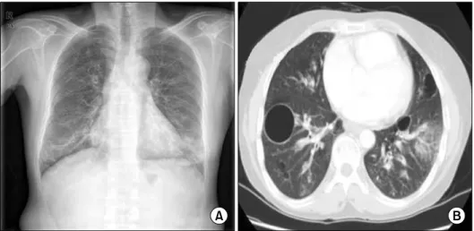 Figure  3.  Histologic  finding  of  wedge  resected  lung  specimen.  (A)  Small  cyst  is  noted  (H&amp;E  stain,  ×10)