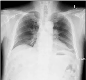 Figure 3. Surgical lung biopsy specimen shows extensive infiltration  by  noncaseating  granulomas  distributed  along  the  pleura,  interlobular  septa,  and  bronchovascular   bun-dles  (H&amp;E  stain,  ×40).